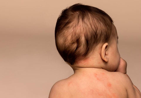 How to Dress a Child During an Eczema Flare-Up - Baby Todd & Co.
