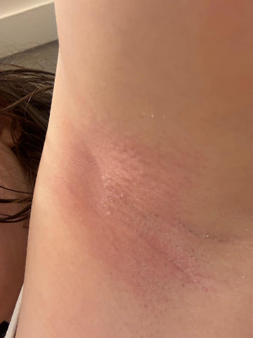 Underarm rash from waxing